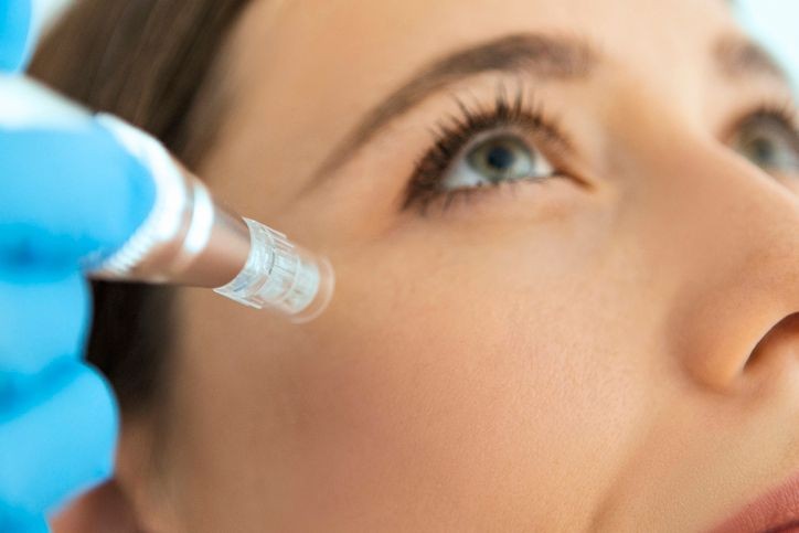 Microneedling o Microagujas Microneedling o Microagujas