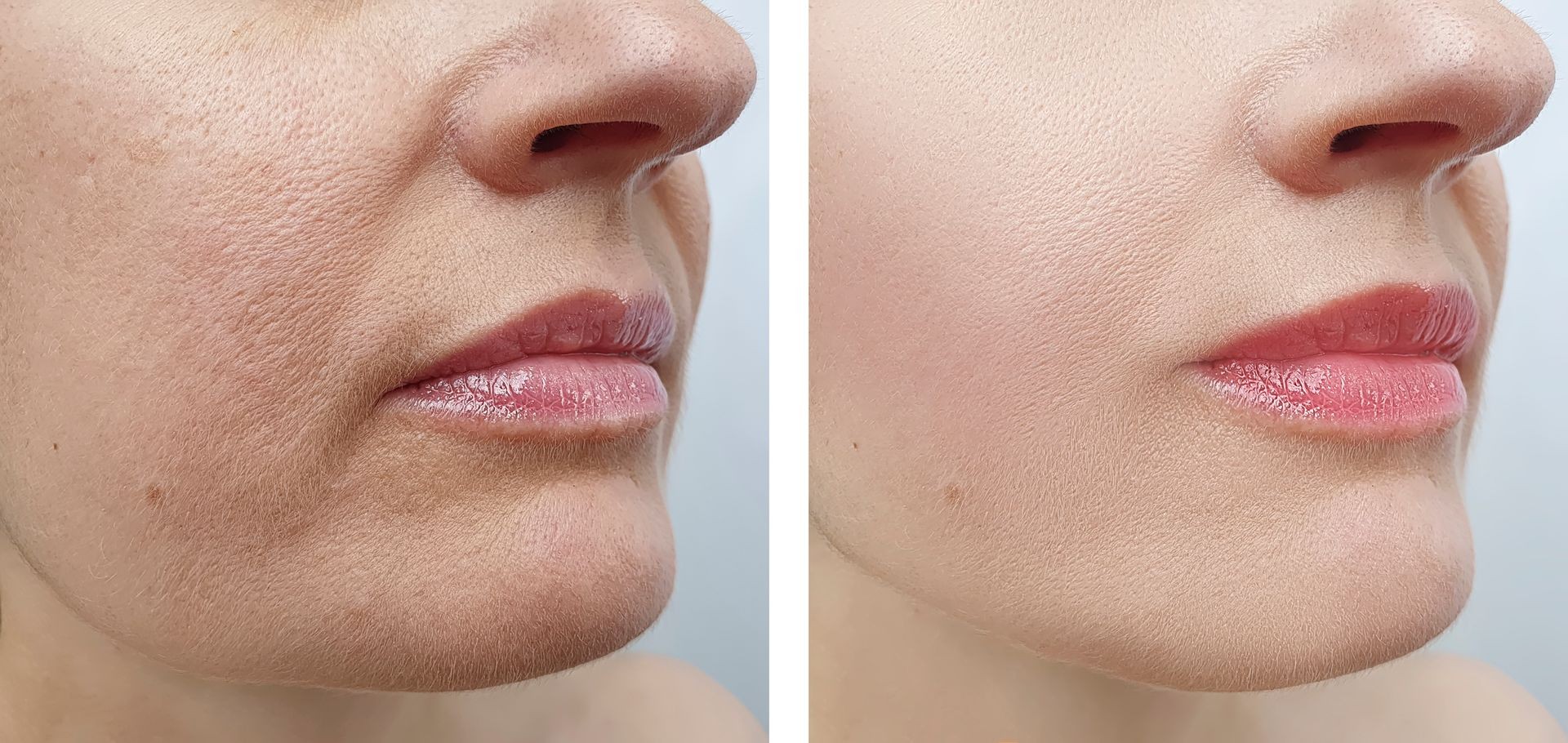 Bioestimuladores faciales Buenos Aires Bioestimuladores faciales Buenos Aires