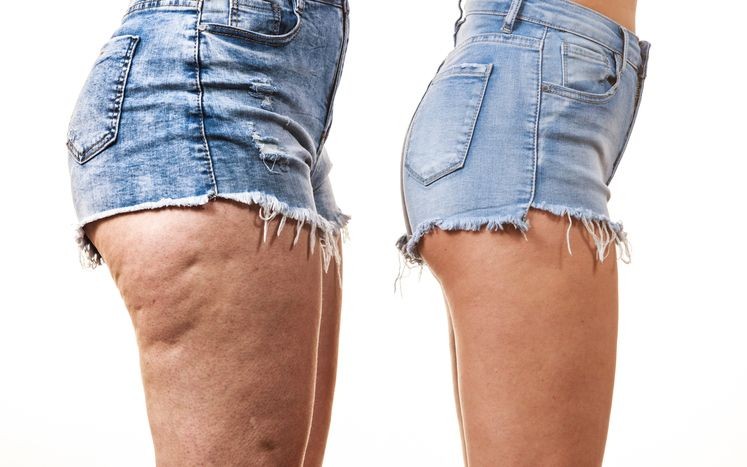 Como eliminar celulitis de los gluteos eficazmente Como eliminar celulitis de los gluteos eficazmente