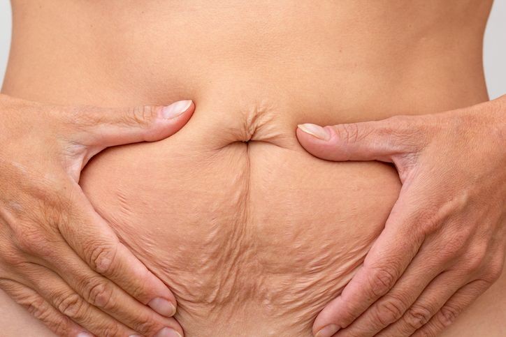 Tensado abdominal con Radiesse Tensado abdominal con Radiesse